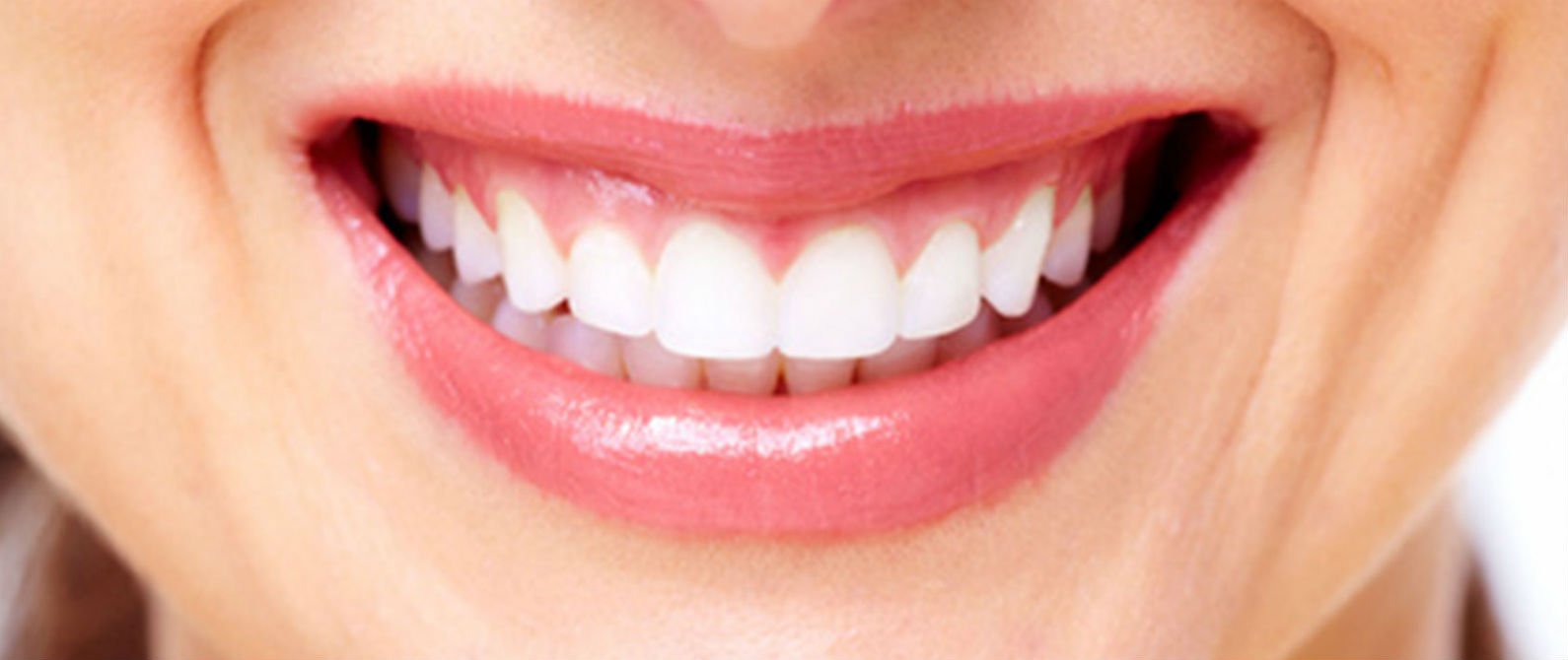 Blanqueamiento de dientes