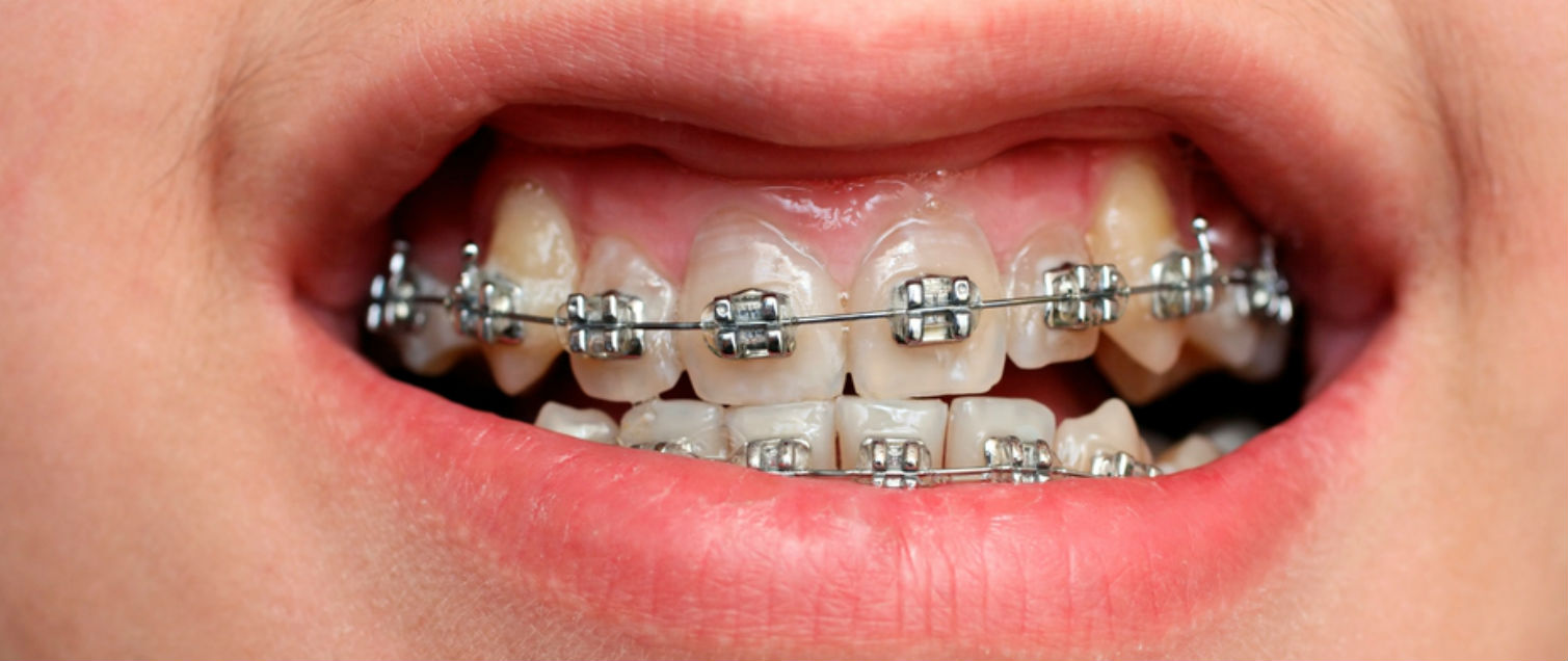 Cuando tengo que usar brakets o frenos