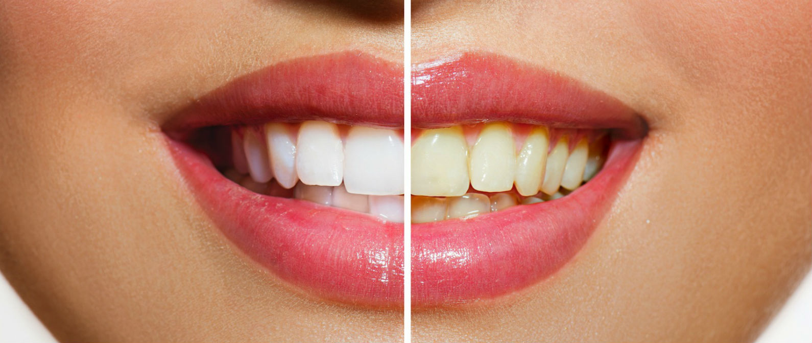 Mitos del blanqueamiento de dientes