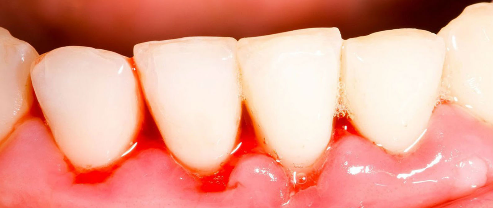 Causas de la gingivitis