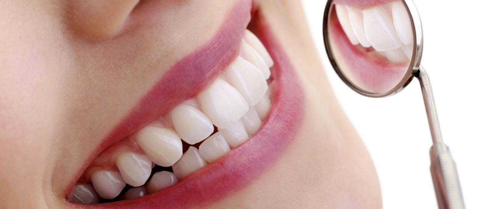 diferencias entre las carillas y coronas dentales