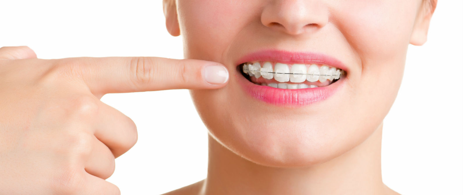 Mitos sobre los brackets