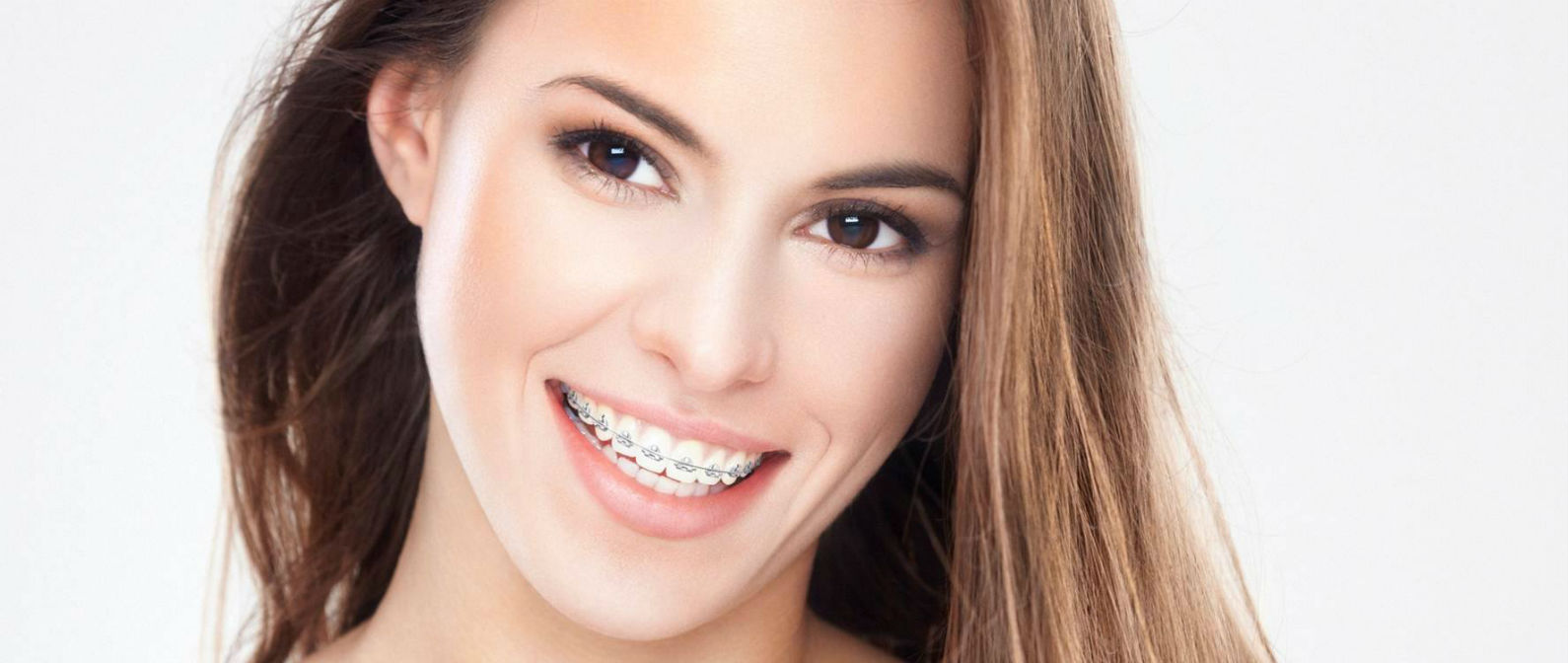 Quién necesita brackets