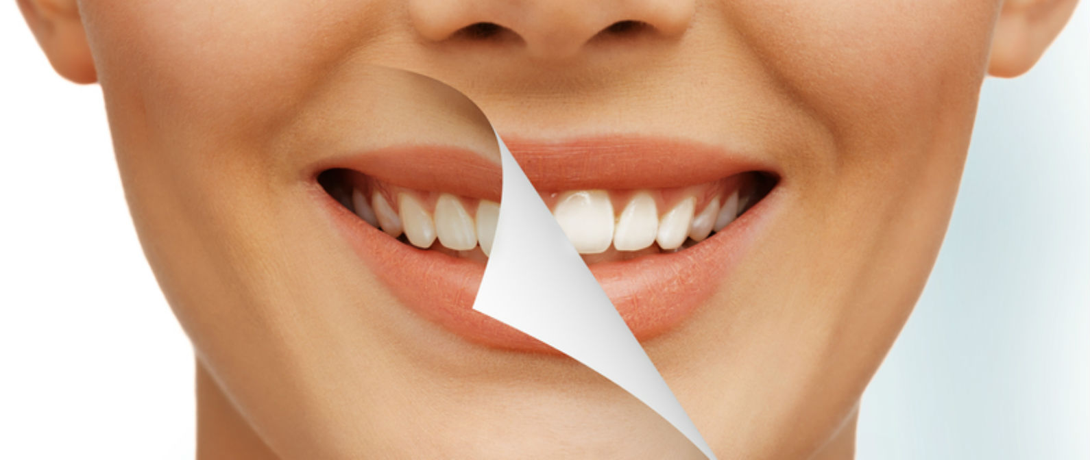 promoción en blanqueamiento de dientes julio