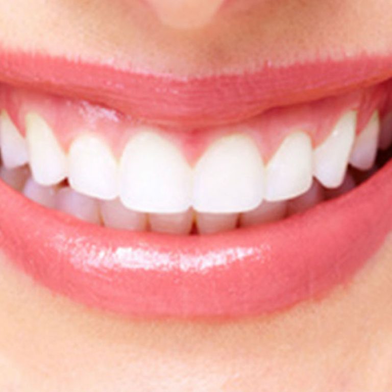 Blanqueamiento de dientes