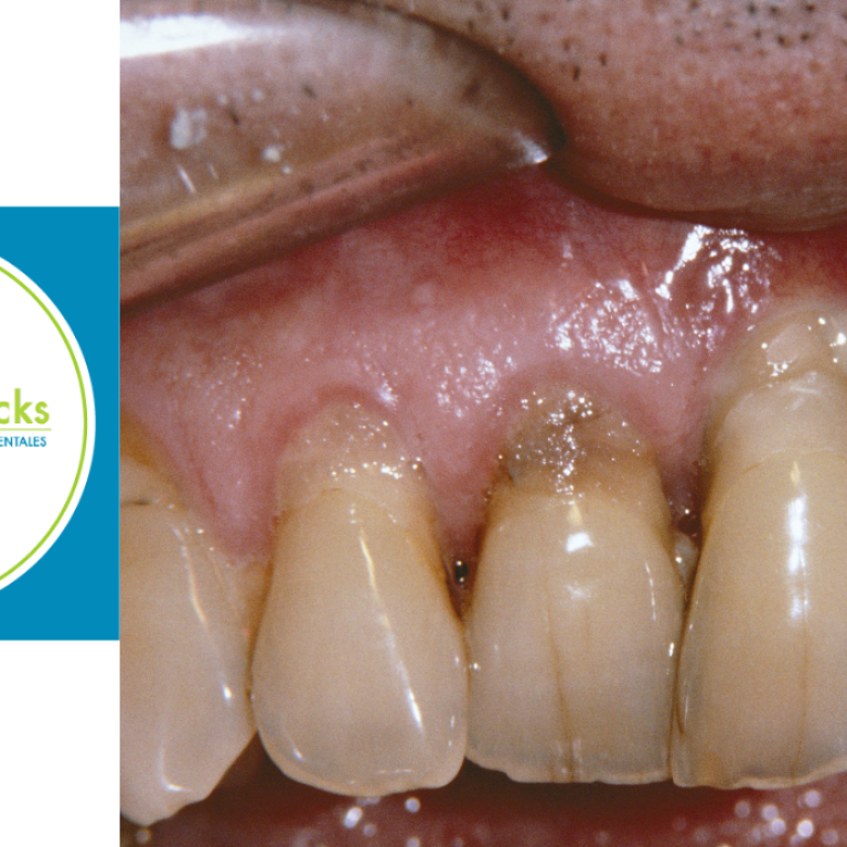 Periodontitis odontotecks