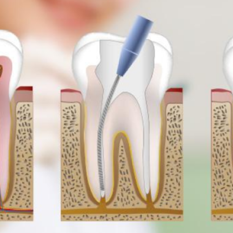 Tratamiento de conducto jpg