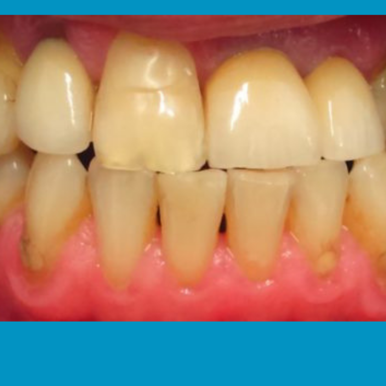 dientes amarillos jpg