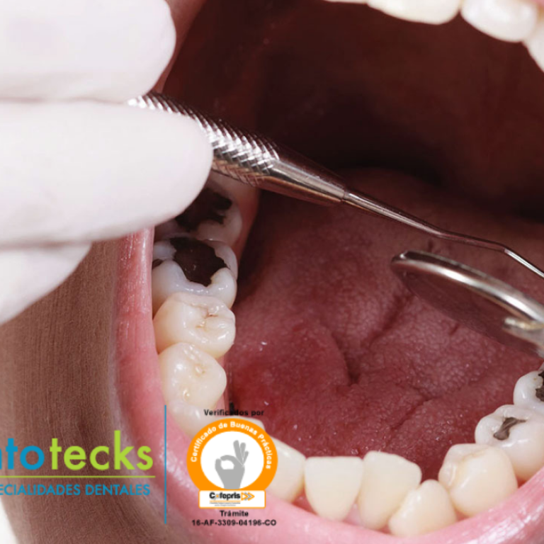 caries odontotecks jpg