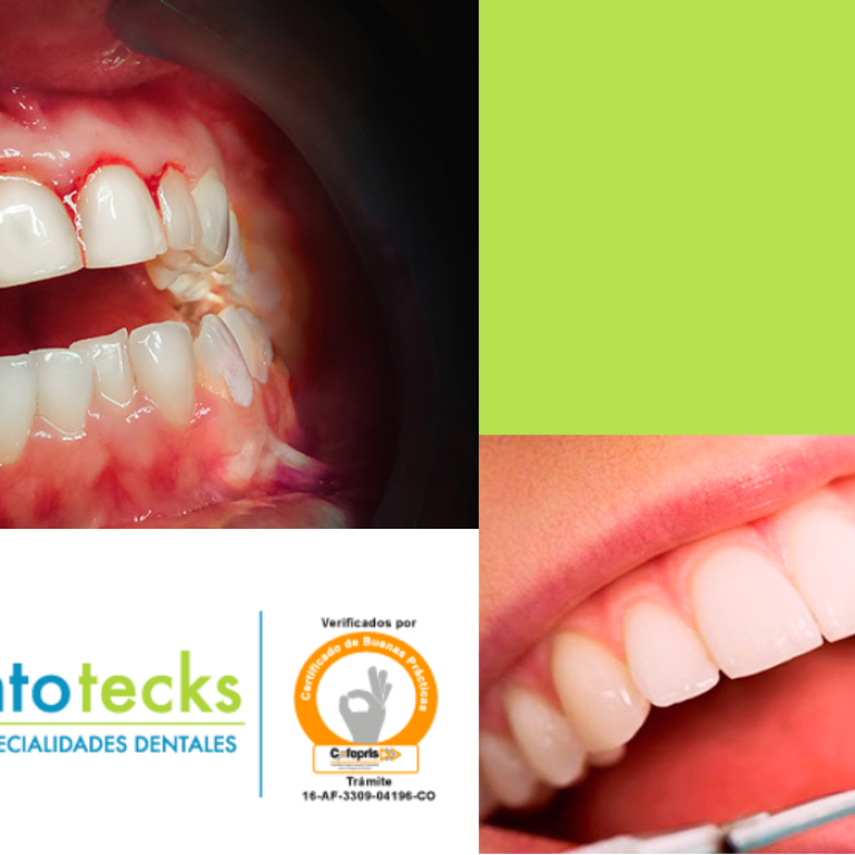 Dientes flojos periodontitis jpg