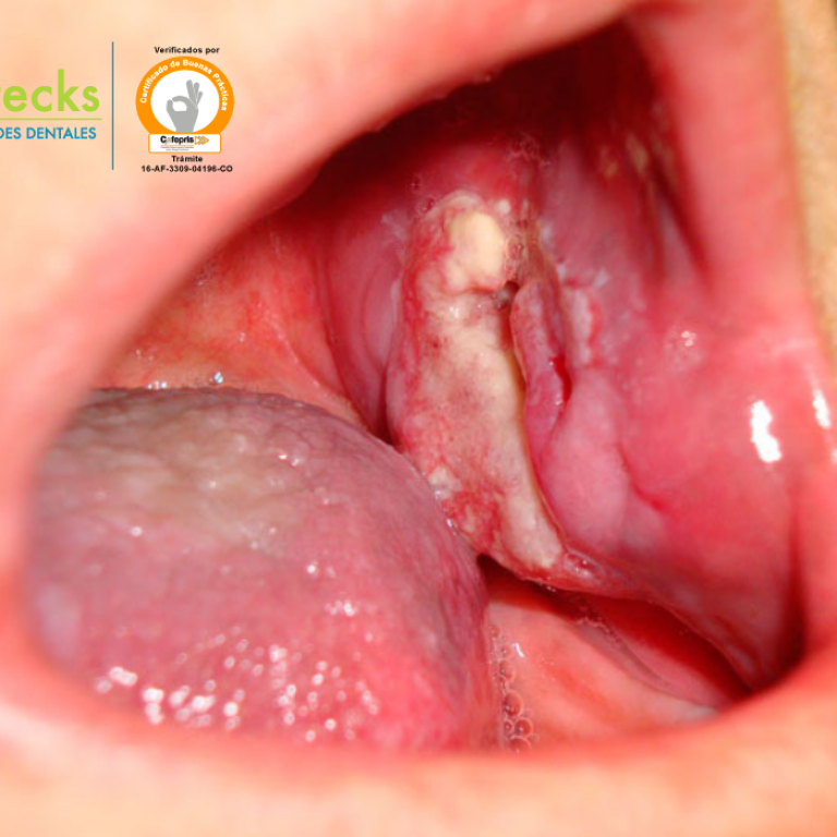 Cáncer de boca jpg