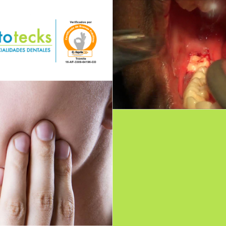 Periocoronaritis jpg