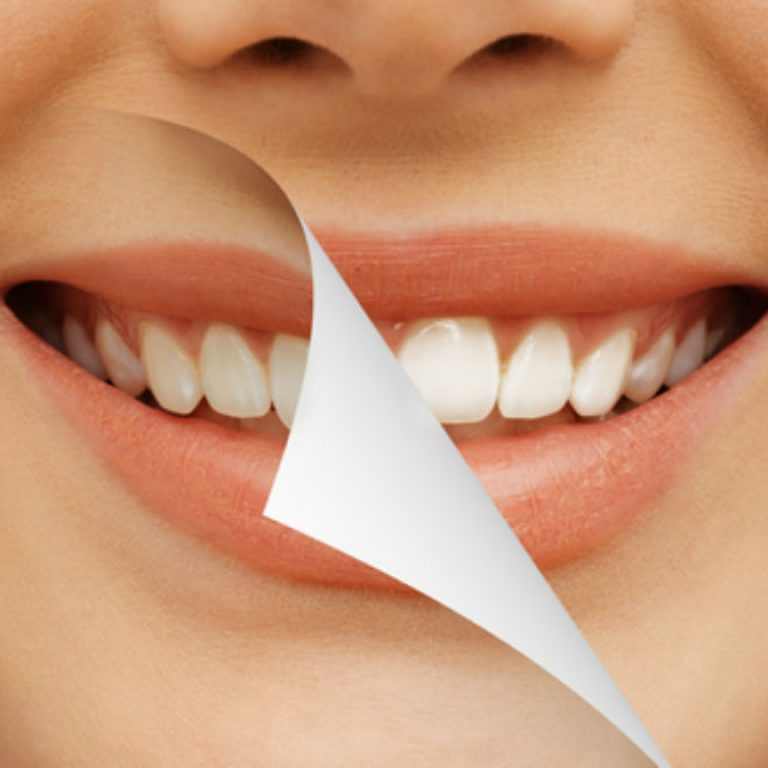 promoción en blanqueamiento de dientes julio