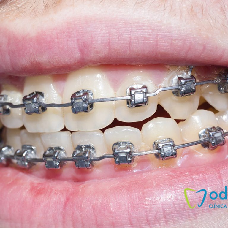 brackets-odonto