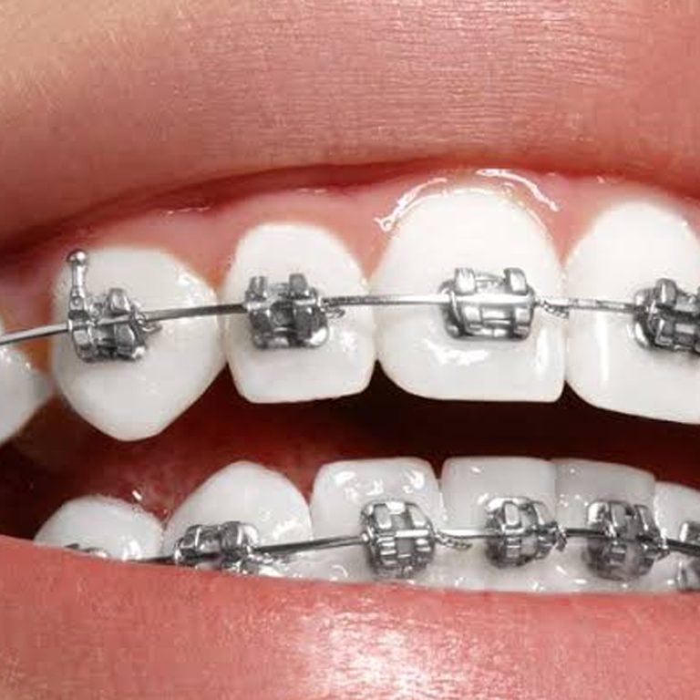 brackets.frenillos