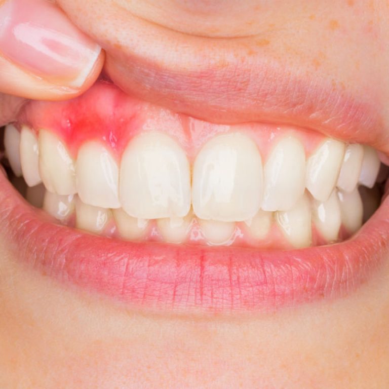 Causas de la gingivitis