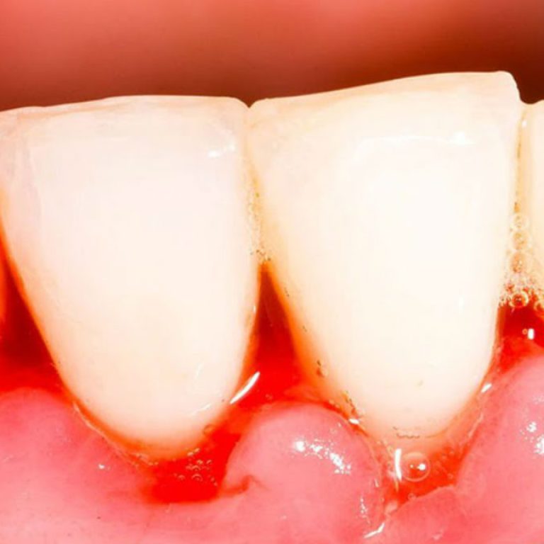 Causas de la gingivitis