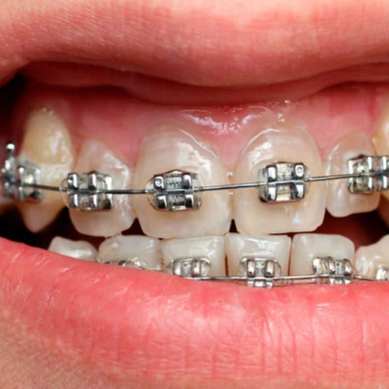 Cuando tengo que usar brakets o frenos