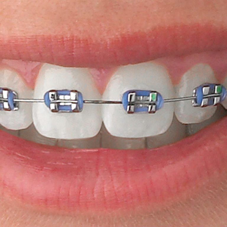 Tips para el cuidado de los brackets