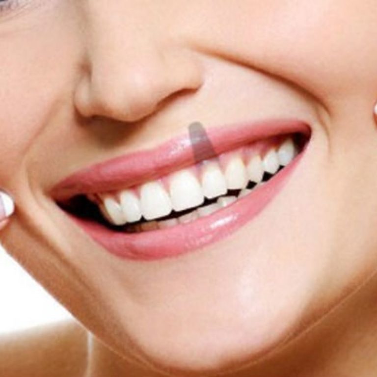 cuidados-implantes-dentales-valencia