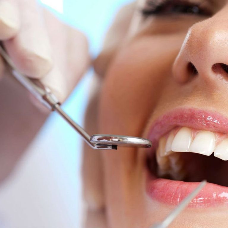 descuento en carillas dentales todo marzo