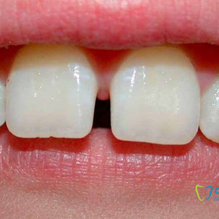 diastema