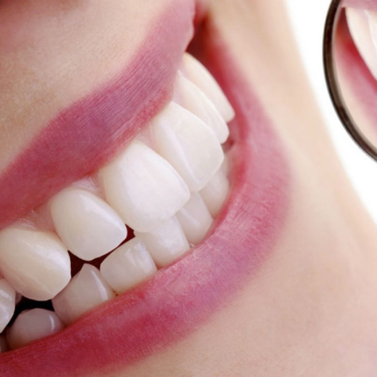 diferencias entre las carillas y coronas dentales