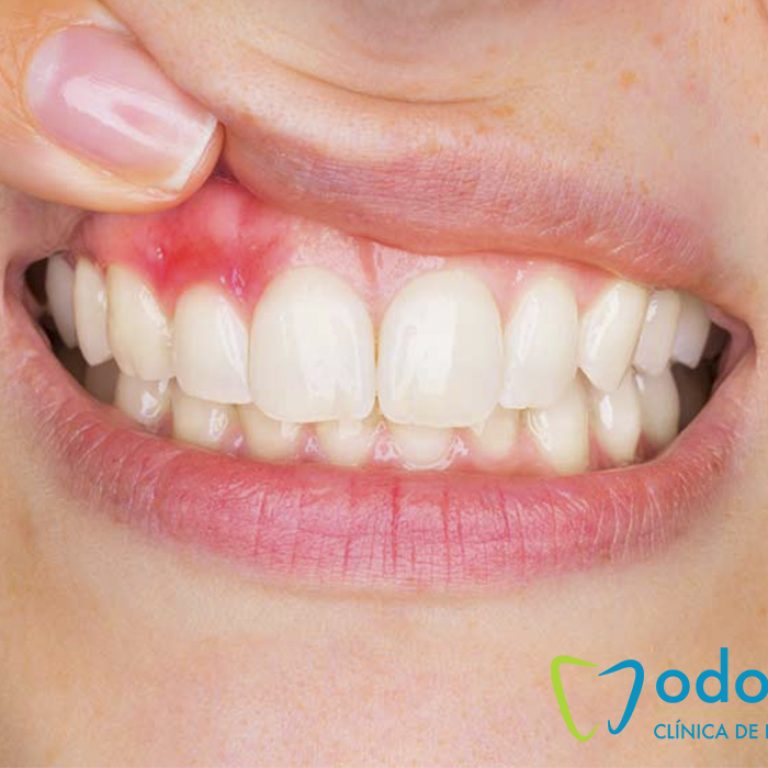 encias-rojas-inflamadas