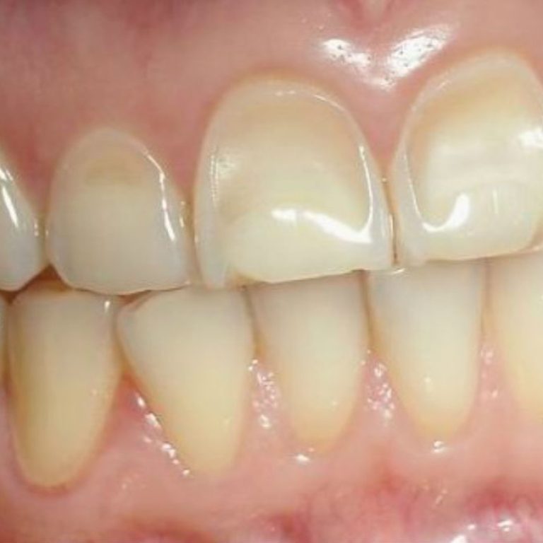 Erosión dental y lo que lo ocasiona