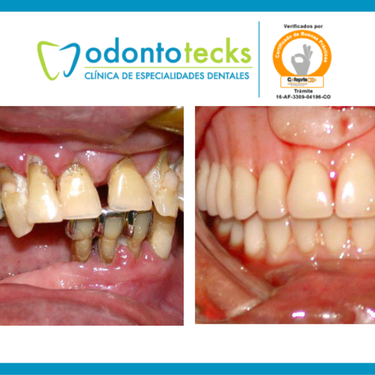 regularización alveolar reborde jpg