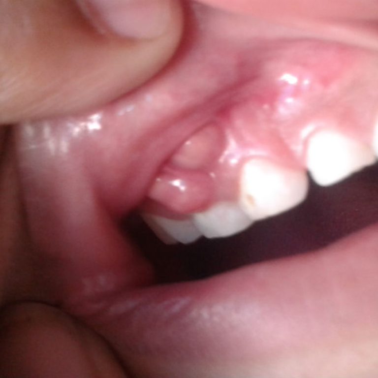 Identifica un absceso dental