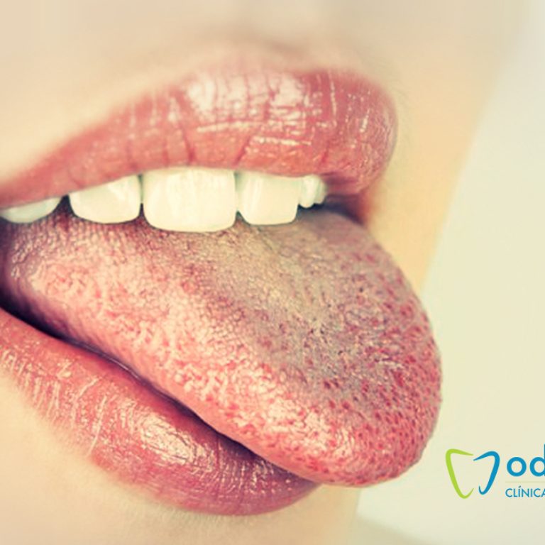 lengua-blanca-causas-y-tratamientos2