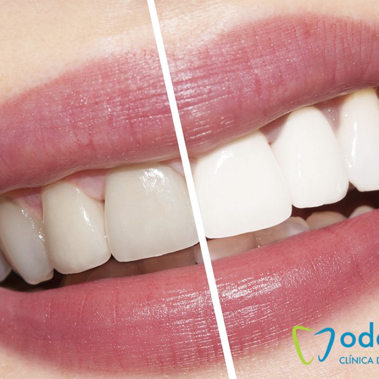 limpiezaultrasónica