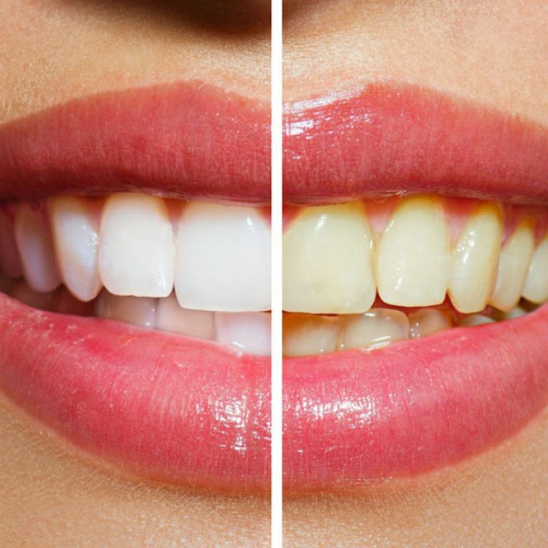Mitos del blanqueamiento de dientes