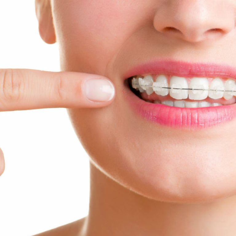 Mitos sobre los brackets