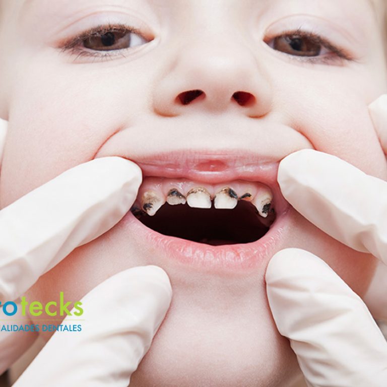 niño-caries