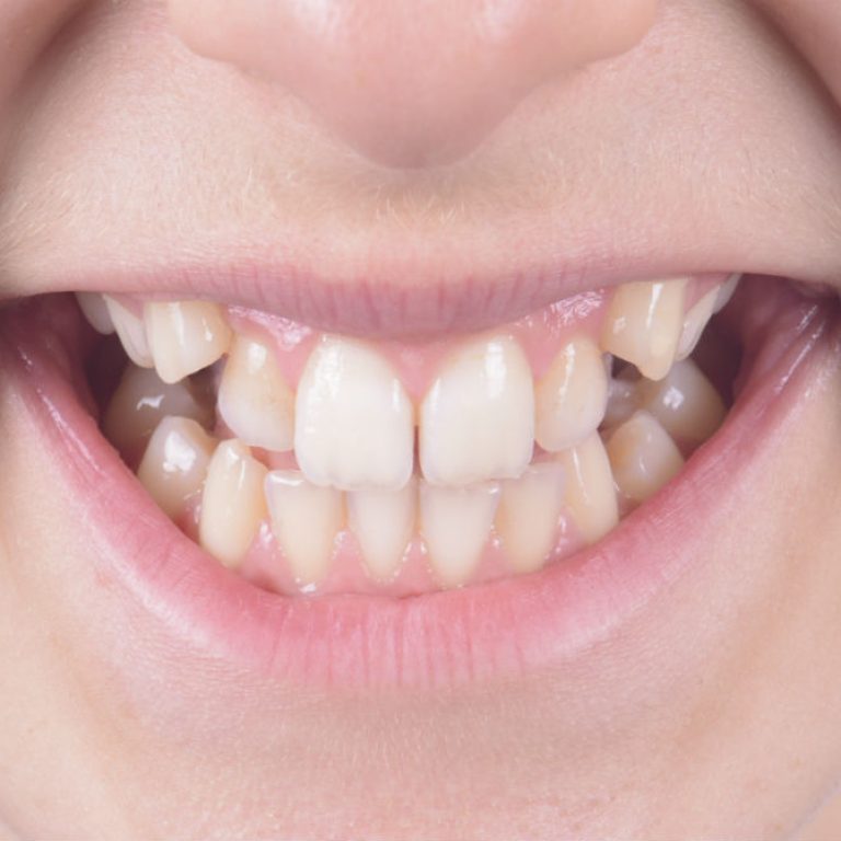 Problemas de tener los dientes chuecos