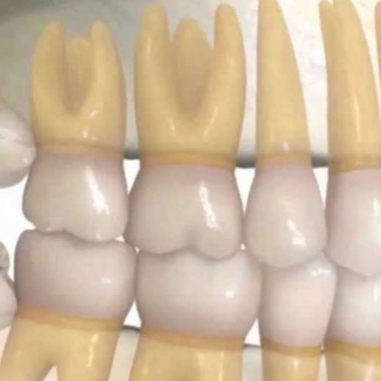 Problemas por las muelas del juicio