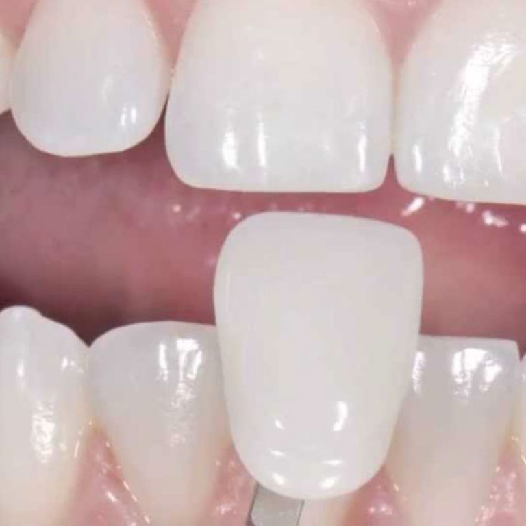 Qué son las carillas dentales