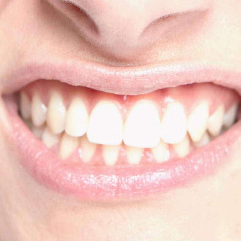 Rechinas los dientes