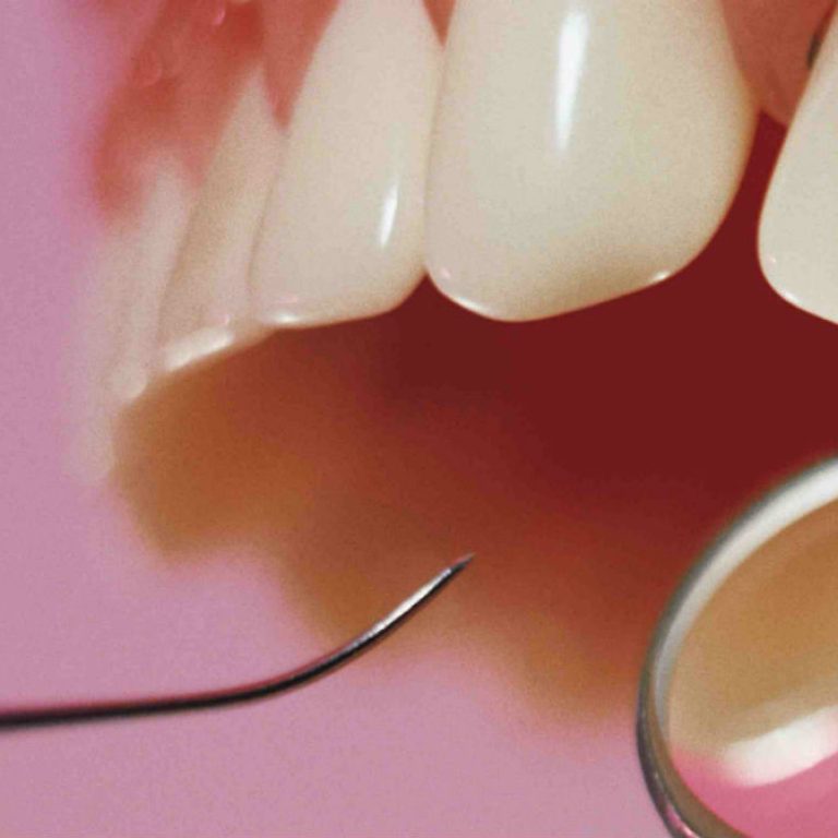 ventajas-de-las-resinas-dentales