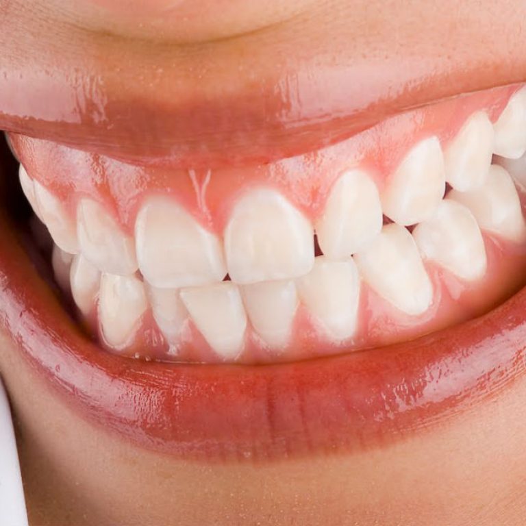 Sangrado de encías, gingivitis