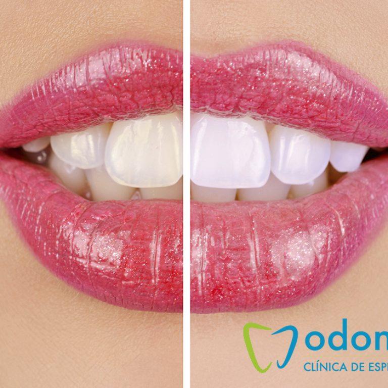 sonrisa-blanqueamiento