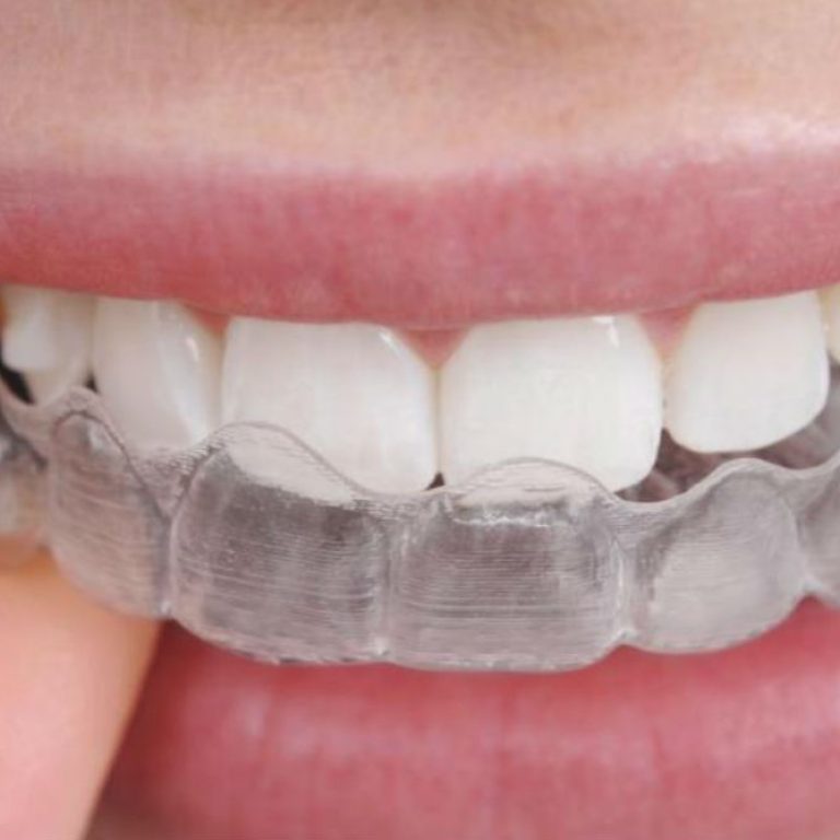 Tips contra el rechinado de dientes
